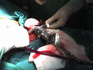 Entrecruzamiento de cordones visualizado durante la realización de la cesárea.