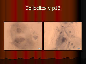 Colilocitos. Negatividad para p16. Infección =/integración.
