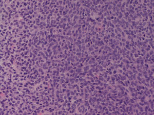 Tumor de células de la granulosa- patrón de crecimiento difuso (HE x200 en negativo original).