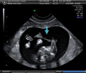 Corte ecográfico a nivel del tórax fetal en el que se observa brida amniótica hiperrefringente (flecha) en estrecho contacto con miembro superior a nivel del codo y antebrazo.