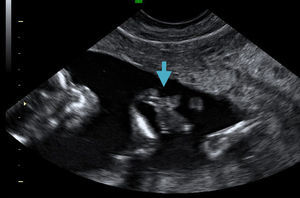 Corte longitudinal fetal en que observa una banda fibrosa (flecha) adherida a la mano fetal.