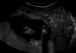 Malposición de miembro inferior fetal secundaria a brida amniótica. Se observa en el mismo corte ecográfico la rodilla, pierna y pie con una clara malposición.