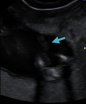 Brida amniótica (flecha) que surge de la pared y se adhiere a miembro inferior fetal.