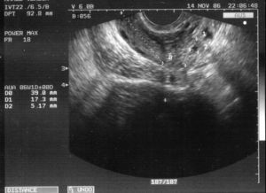 Gestación tubárica junto a ovario derecho (amenorrea de 6 semanas y 3 días).