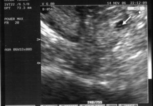 Detalle de la figura 2 (amenorrea de 6 semanas y 3 días). Imagen sospechosa de embarazo tubárico con vesícula vitelina en su interior (flecha).