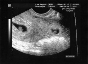Amenorrea de 7 semanas y 3 días. Gestación intrauterina (izquierda de la imagen) con embrión de 5,2mm y gestación tubárica (derecha de la imagen).