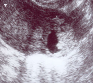 Imagen obtenida por ecografía transvaginal en el momento del diagnóstico del caso 1, en la que se evidencia la gestación ectópica de 21 x 21 x 22mm en el cuerno derecho, en un corte transversal del útero.
