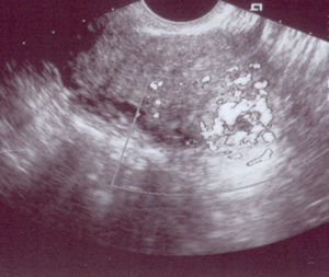 Imagen obtenida por ecografía transvaginal en el momento del diagnóstico del caso 2, en la que se evidencia en el cuerno uterino izquierdo imagen de 20 x 20mm compatible con gestación intersticial. El estudio Doppler permite observar la morfología típica de las arterias peritrofoblásticas.