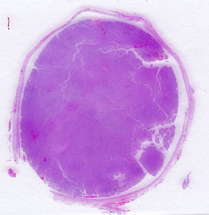 En este corte histológico se puede observar la pared de la trompa adelgazada y el interior ocupado por una masa sólida que constituye la tumoración. (HE, x1.).