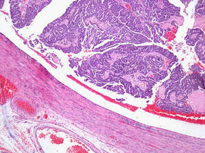 Imagen histológica del carcinoma seroso tubárico con marcado crecimiento papilar. (HE, x20.).
