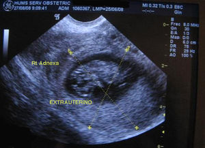 Imagen de gestación ectópica abdominal por ecografía transvaginal.