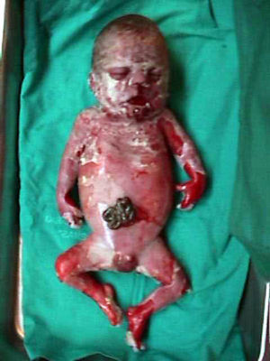 Vista general del feto en el que destaca la presencia de gastrosquisis y deformidades faciales y en extremidades.