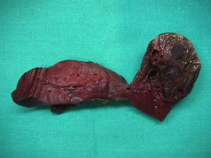 Examen macroscópico del higado fetal en el que se observa tumoración sólida (hemangioma) en la superficie del lóbulo derecho.