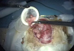 Extracción de la pieza quirúrgica.