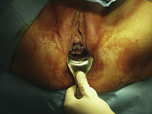 Tumor en la cara anterior de la vagina visto con valva.