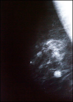 Imagen mamográfica anterior a la aparición del nódulo.