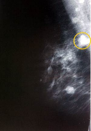 Imagen mamográfica del nódulo palpable de nueva aparición.