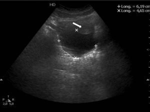 La ecografía abdominal muestra una lesión anecoica y homogénea de localización retrouterina. (Flecha blanca: útero).
