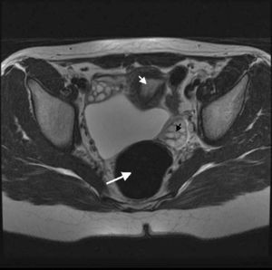 RM potenciada en T2: corte axial. Lesión hiperintensa y bien delimitada, alojada en el espacio de Douglas, entre útero (punta de flecha blanca), ovarios (punta de flecha negra) y sigma (flecha blanca).