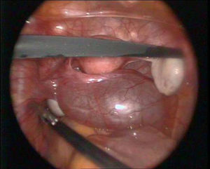 Imagen intraoperatoria del quiste paratubárico donde se muestra la relación de la lesión con la trompa izquierda, quedando ambos ovarios libres y sin alteraciones macroscópicas.
