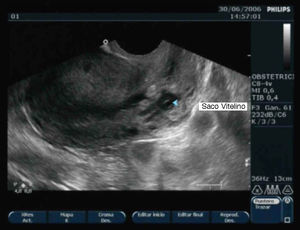 Imagen ecográfica del embarazo ectópico cervical con saco vitelino.