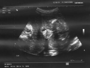 Ecografía de la semana 31. A la izquierda: región dorsal del feto acardio. Pueden apreciarse en la imagen elementos óseos hipodesarrollados rodeados de tejido edematizado típico de estos fetos1,2. A la derecha: región caudal del primer gemelo.