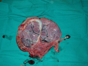 Detalle de la placenta. Véase el cordón del feto acardio (derecha) hipoplásico e insertado velamentosamente.