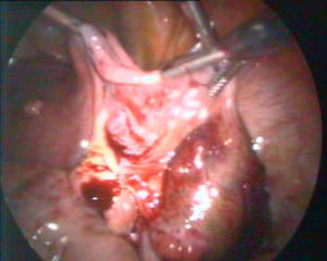 Imagen laparoscópica del embarazo ectópico.