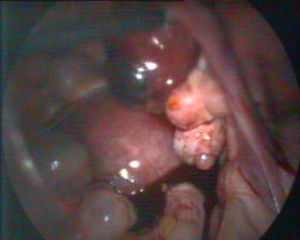 Imagen laparoscópica del embarazo ectópico.