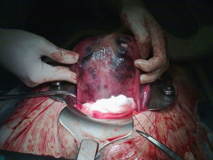 Imagen de la cesárea tras la extracción fetal en la que se aprecia el útero involucionado con una extravasación hemática difusa a través de las fibras miometriales hacia la serosa en la zona del desprendimiento placentario (útero de Couvelaire).