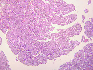 Imagen Microscópica (H-E 10x CGA) de carcinoma villoglandular. Patrón villoglandular con papilas altas y delgadas recubiertas de epitelio cilıíndrico estratificado.