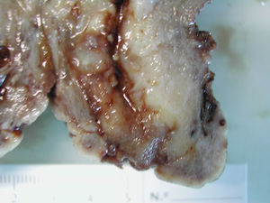Imagen macroscópica al corte, con crecimiento exofítico en labio anterior de cervix correspondiente al caso clínico número 2.