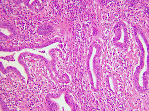 Imagen microscópica (H-E 40x CGA). E epitelio cilíndrico estratificado que presenta solo leves atipias nucleares y escasas figuras mitóticas.