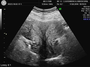 Imagen del útero septo completo con duplicidad cervical y tabique vaginal. Ecografía transabdominal.