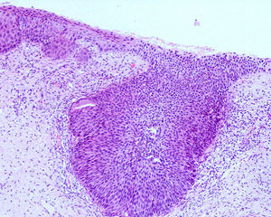 Mucosa cervical donde se observa una lesión HSIL con afectación de las glándulas endocervicales.