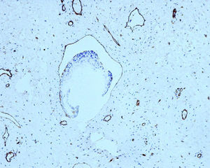 Tejido neoplásico cervical en el interior de un espacio vascular con tinción inmunohistoquímica del endotelio para el marcador CD31.