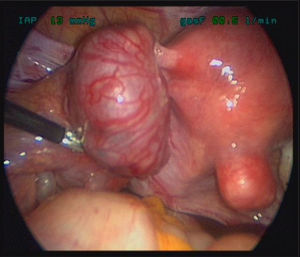 Hallazgos laparoscópicos: trompa izquierda engrosada, mioma subseroso en la cara posterior.