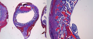 Anatomía patológica microscópica: gestación ectópica.