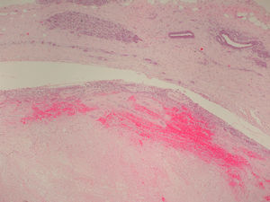 Tinción de hematoxilina-eosina de corte histológico del nódulo (parte inferior) y de la mama adyacente (parte superior). El nódulo está infartado de forma casi completa, observándose áreas de hemorragia sin apenas tejido viable en la periferia.