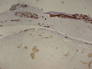 La imagen que la Figura 2, teñida con citoqueratina AE1-3, pone de manifiesto la existencia de dúctulos residuales en la zona infartada (parte inferior). En la mama normal (parte superior) la citoqueratina tiñe el epitelio ductal.