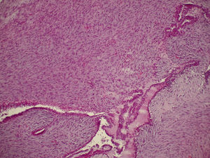 Corte histológico de tumoración fibroepitelial con estroma altamente celular, moderada atipia y 10 mitosis×10 campos de gran aumento. El componente epitelial no presenta alteraciones.