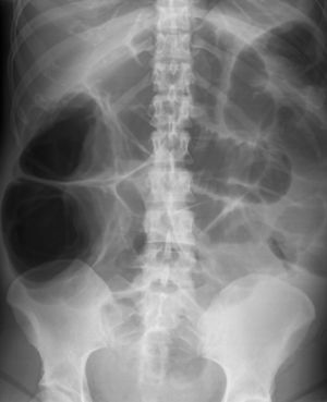Radiografía abdominal. Distensión del área cecal típico de síndrome de Ogilvie.