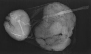 Radiografía de la placenta y del feto acardio.