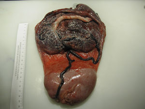 Placenta única y dos cordones umbilicales. El cordón del feto acardio procede del cordón del donante, existiendo múltiples anastomosis entre ambas circulaciones fetales.
