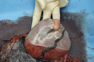 Feto acardio de 10 × 9 × 3cm. Detalle de las falanges del pie.