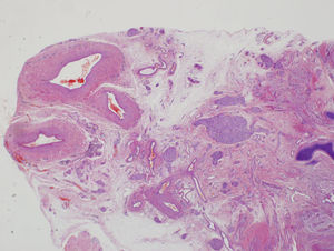 Visión panorámica de un corte de la inserción del cordón del feto acardio. Se visualizan tres luces vasculares, correspondiendo a dos arterias y una vena.
