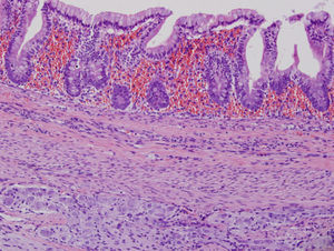 Presencia de epitelio colónico en el feto acardio.