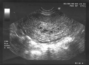 Imagen ecográfica del diagnóstico de aborto diferido. Recuerda a la imagen característica de «panal de abejas».