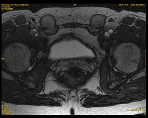 Imagen de resonancia magnética T2, corte transversal. Se visualiza una imagen bilateral a nivel de canal inguinal, correspondiente a gónadas masculinas.