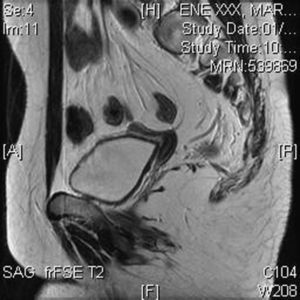 RM con rudimento uterino no visible en laparoscopia.